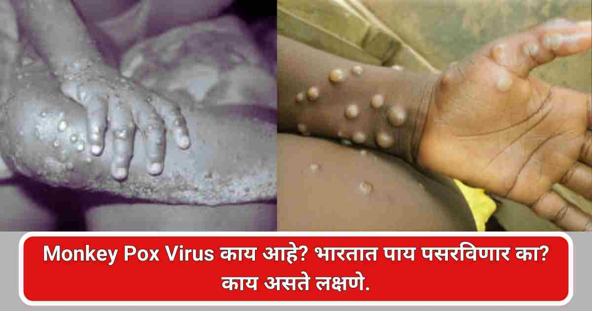 Monkey Pox Virus काय आहे? भारतात पाय पसरविणार का? काय असते लक्षणे.